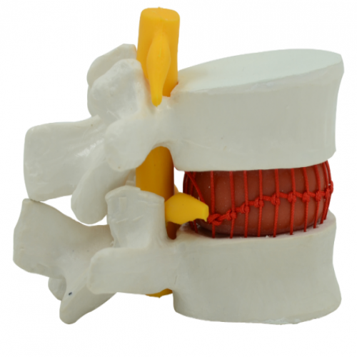 椎间盘突出模型（动态演示）
